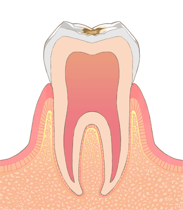 虫歯イラストC0C1
