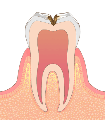 虫歯イラストC2