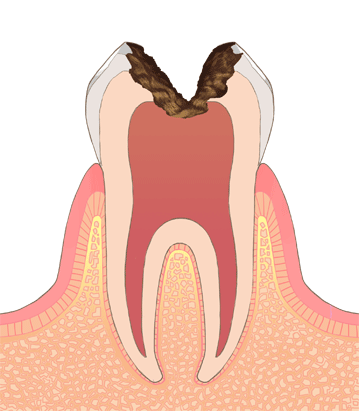 虫歯イラストC3